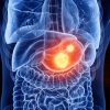 Gastric Cancer