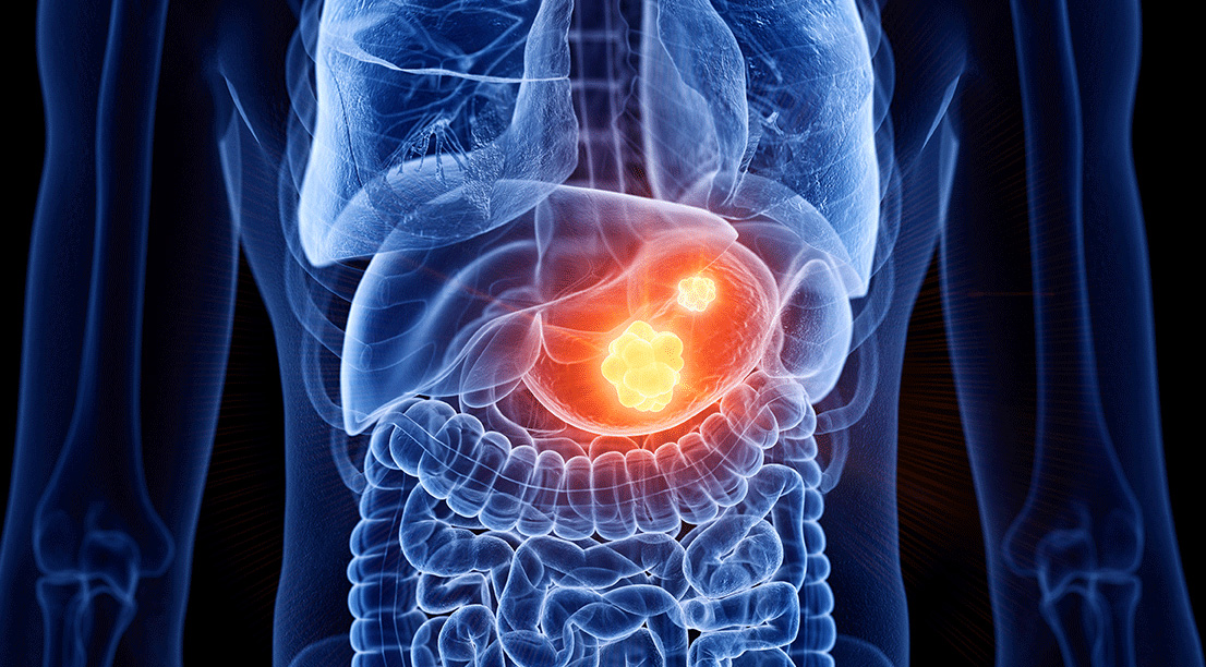 Gastric Cancer